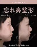 忘れ鼻整形 before画像 サムネイル用