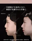 忘れ鼻整形 30日後 サムネイル用