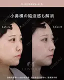 忘れ鼻整形 30日後 サムネイル用