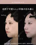 忘れ鼻整形 30日後 サムネイル用