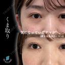 クマ取り after画像 サムネイル用
