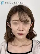 ３D脂肪吸引(頬・顎下)/メーラーファット/糸リフトアップ/バッカルファット除去 60日後 サムネイル用