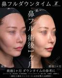 鼻フルダウンタイム 30日後 サムネイル用