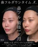 鼻フルダウンタイム before画像 サムネイル用