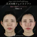 王式切開フェイスリフト 180日後 サムネイル用