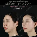 王式切開フェイスリフト 180日後 サムネイル用