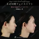 王式切開フェイスリフト 180日後 サムネイル用