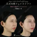 王式切開フェイスリフト 180日後 サムネイル用