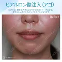 【20代女性・顎ヒアルロン酸注入】ジュビダームビスタ ボラックス before画像 サムネイル用