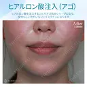 【20代女性・顎ヒアルロン酸注入】ジュビダームビスタ ボラックス 7日後 サムネイル用