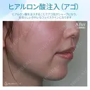 【20代女性・顎ヒアルロン酸注入】ジュビダームビスタ ボラックス 7日後 サムネイル用
