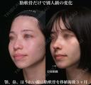 肋軟骨による鼻中隔延長 90日後 サムネイル用