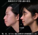 肋軟骨による鼻中隔延長 90日後 サムネイル用
