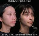 肋軟骨による鼻中隔延長 90日後 サムネイル用
