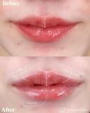 唇ヒアルロン酸 before画像 サムネイル用
