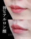 唇ヒアルロン酸 after画像 サムネイル用