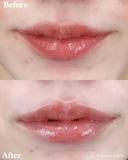唇ヒアルロン酸 after画像 サムネイル用