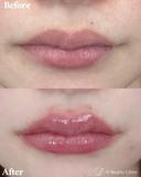唇ヒアルロン酸 before画像 サムネイル用