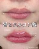 唇ヒアルロン酸 after画像 サムネイル用