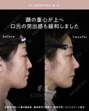 忘れ鼻整形 30日後 サムネイル用