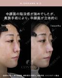 忘れ鼻整形 30日後 サムネイル用