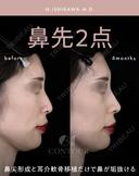 忘れ鼻整形 before画像 サムネイル用