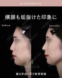 忘れ鼻整形 180日後 サムネイル用