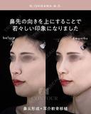 忘れ鼻整形 180日後 サムネイル用