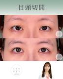 目頭切開 before画像 サムネイル用