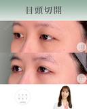 目頭切開 after画像 サムネイル用