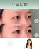 目頭切開 after画像 サムネイル用