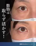 MD式裏ハムラ法 before画像 サムネイル用