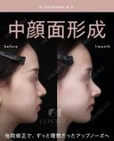 忘れ鼻整形 before画像 サムネイル用
