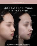 忘れ鼻整形 30日後 サムネイル用