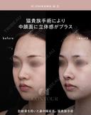 忘れ鼻整形 30日後 サムネイル用