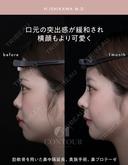 忘れ鼻整形 30日後 サムネイル用