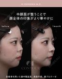 忘れ鼻整形 30日後 サムネイル用