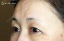 【50代女性・ハードコンタクトレンズ眼瞼下垂】切らない眼瞼下垂+α法（術直後） 0日後 サムネイル用