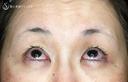 【50代女性・ハードコンタクトレンズ眼瞼下垂】切らない眼瞼下垂+α法（術直後） 0日後 サムネイル用