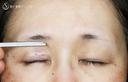 【50代女性・ハードコンタクトレンズ眼瞼下垂】切らない眼瞼下垂+α法（術直後） 0日後 サムネイル用