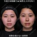 全部自家組織でACRを整え人中を短く 90日後 サムネイル用