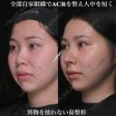 全部自家組織でACRを整え人中を短く 90日後 サムネイル用