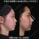 全部自家組織でACRを整え人中を短く 90日後 サムネイル用
