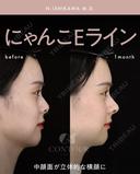忘れ鼻整形 before画像 サムネイル用