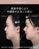 忘れ鼻整形 30日後 サムネイル用