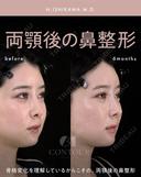 忘れ鼻整形 180日後 サムネイル用