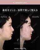 忘れ鼻整形 180日後 サムネイル用