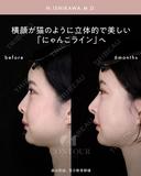 忘れ鼻整形 180日後 サムネイル用
