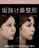 忘れ鼻整形 before画像 サムネイル用