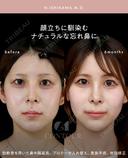 忘れ鼻整形 180日後 サムネイル用